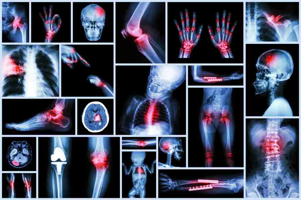 Car Accident Injuries