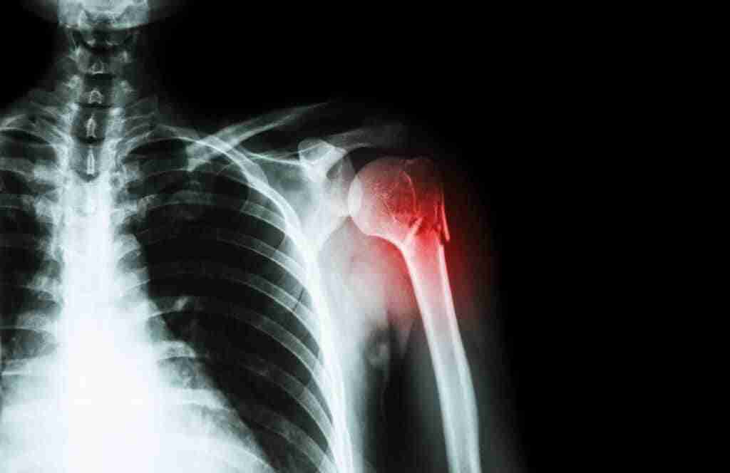 Fracture At Neck Of Humerus ( Arm Bone ) ( Film X-ray Left Shoul