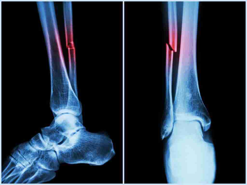 Fracture Shaft Of Fibula Bone ( Leg Bone ) . X-ray Of Leg ( 2 P