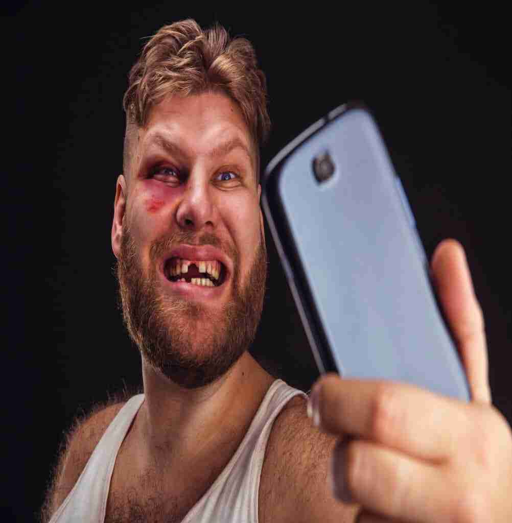 Man with bruise takes selfie